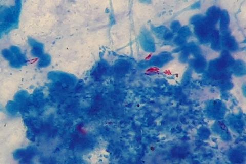 Mycobacterium_tuberculosis_in_Ziehl-Neelsen_stained_smear_of_sputum