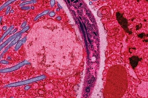 Malaria