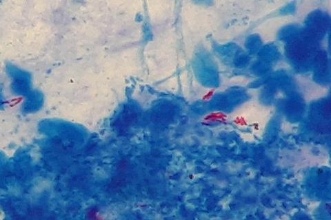 Mycobacterium_tuberculosis_in_Ziehl-Neelsen_stained_smear_of_sputum