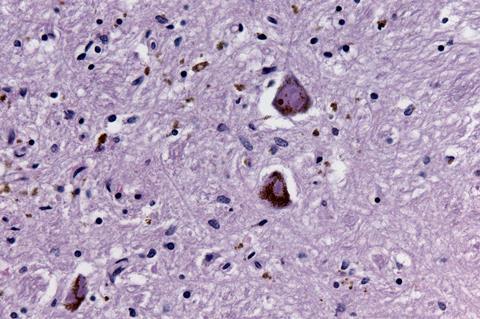 Eosinophilic_inclusions_parkinson_HE