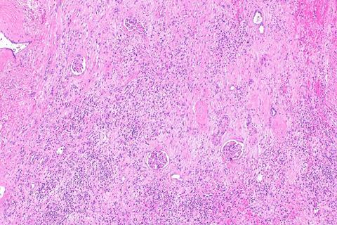 960px-Kidney_with_chronic_inflammation_and_fibrosis_--_low_mag