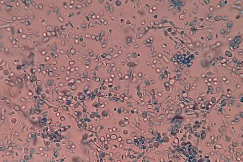 Malassezia_in_LPCB_Tease_Mount_Microscopy