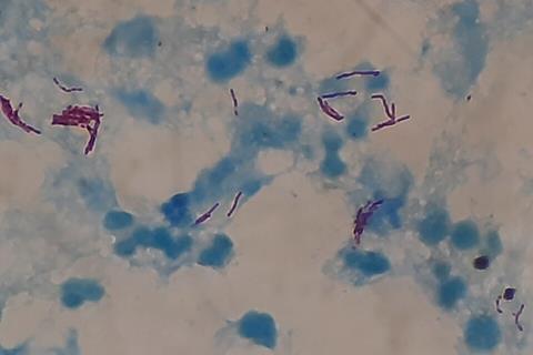 Acid_fast_bacilli_of_Mycobacterium_tuberculosis