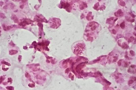 N._gonorrhoeae_in_pus