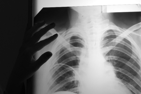 Low-Res_X-Ray from a TB patient.png