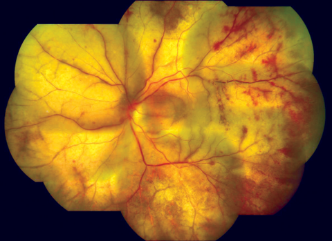 PMID20029144_05_progressive_outer_retinal_necrosis_-_cracked_mud
