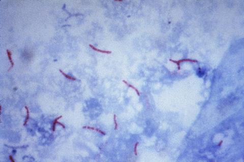 Mycobacterium_tuberculosis_Ziehl-Neelsen_stain_02