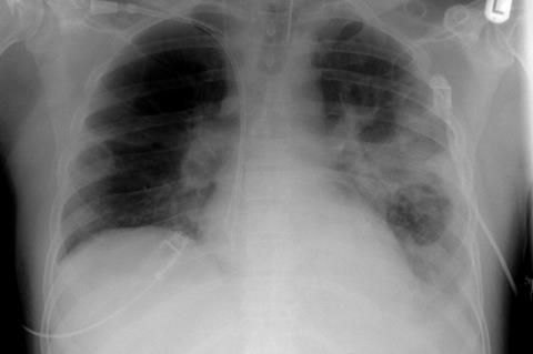 XR_chest_-_pneumonia_with_abscess_and_caverns_-_d0