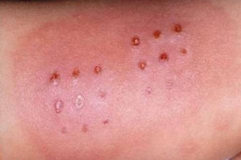 Réaction_inflammatoire_BCG_lors_maladie_de_kawasaki