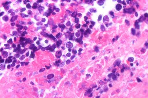 Small_cell_carcinoma_infected_with_herpes_simplex_virus_-_Case_260_(8540530672)