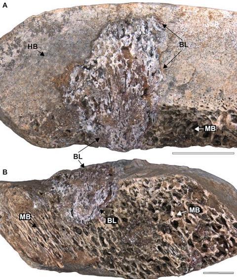 Low-Res_osteomyelitis