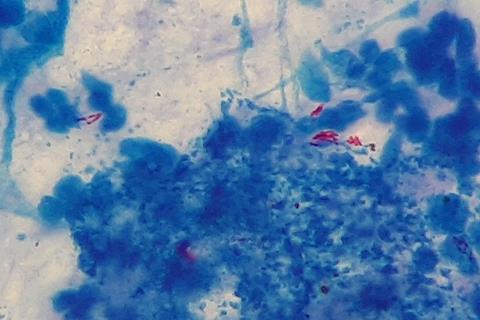 Mycobacterium_tuberculosis_in_Ziehl-Neelsen_stained_smear_of_sputum (1)