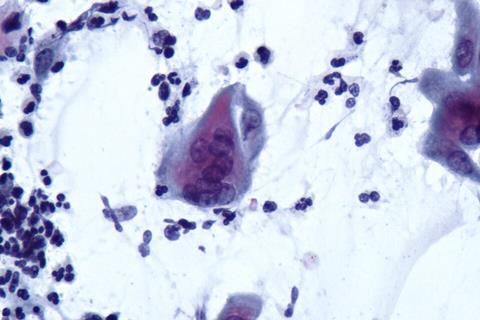 Infección_vaginal_por_virus_herpes_(9361174718)