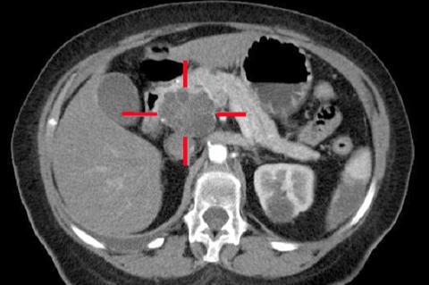 Pancreatic carcinoma