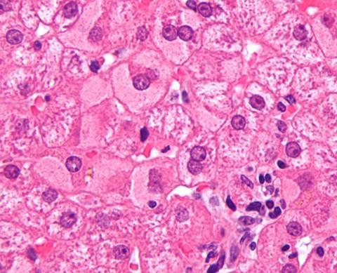 Ground_glass_hepatocytes_high_mag_cropped_2