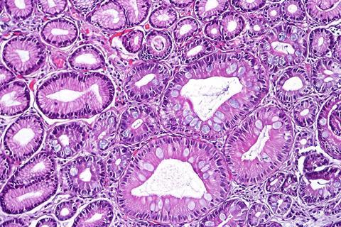 Gastric intestinal metaplasia, high magnification