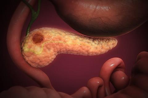 Pancreatic_Cancer