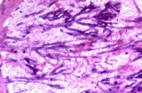 Aspergillosis,_angioinvasive,_intravascular_(5390967599)