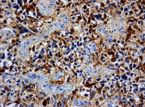 Glioblastoma_GFAP