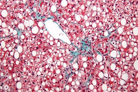 960px-Non-alcoholic_fatty_liver_disease1