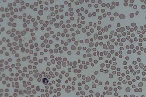 Thrombocytopenia_1