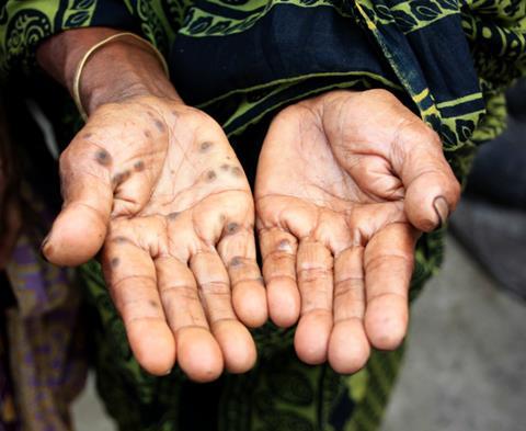 Arsenic_Poisoning