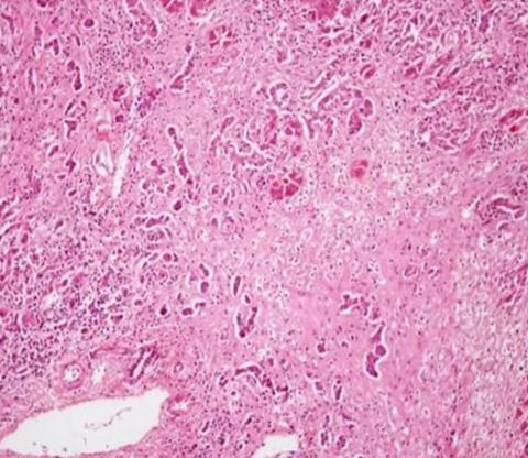 Histopathology_of_massive_hepatic_necrosis_in_hepatitis_B