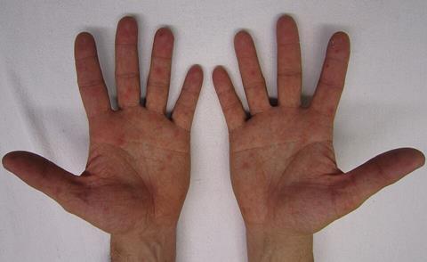 Characteristic_rash_of_hand,_foot,_and_mouth_disease,_on_human_hands