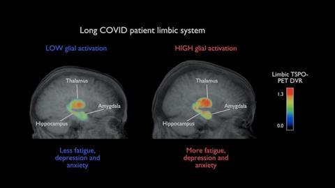 Low-Res_Covid-patient_brain-image