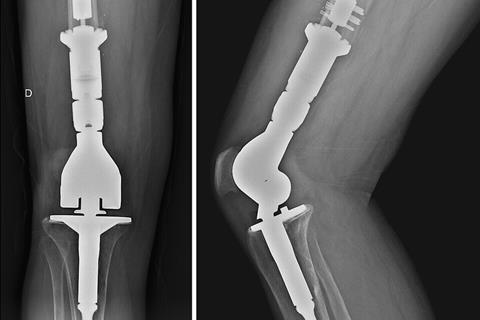 Knee_arthroplasty_due_to_a_chondrosarcoma_2
