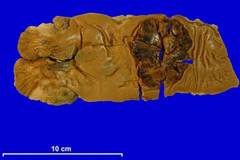 Colorectal adenocarcinoma human
