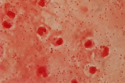 Gram_negative_coccobacilli_of_Acinetobacter_in_bronchoalveolar_lavage_(BAL)_Gram_staining