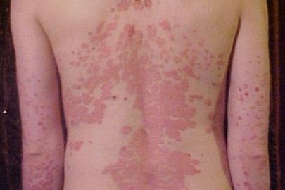 Psoriasis_on_back1