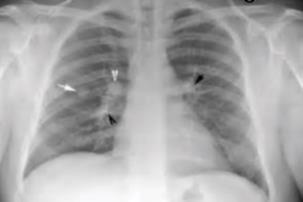 Chest_X-ray_of_discrete_round_nodules_after_secondary_tuberculosis