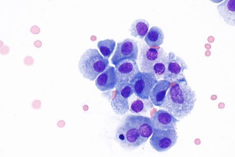 Macrophages_in_bronchial_wash_specimen_--_very_high_mag