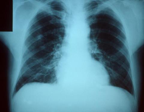 Pneumonia_x_ray