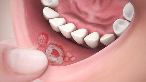 Stomatitis