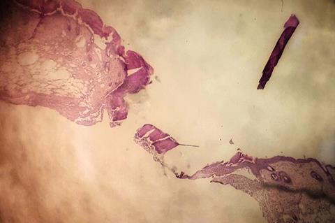 Histological_Analysis_of_Diabetic_Skin_3_Days_Post_Wounding