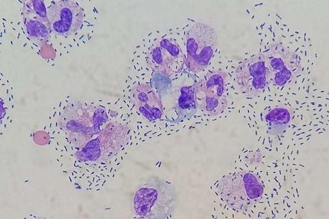 Cerebrospinal_fluid_differential_in_bacterial_meningitis_-_Wright-Giemsa_stain