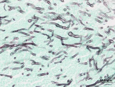 Pulmonary_aspergillosis_(2)_invasive_type