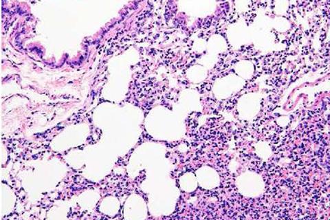 pulmonary_fibrosis-m-1140x760