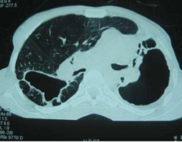 Bilateral_fibrosis_and_pleural_thickening_in_an_infection_with_non-tuberculosis_mycobacteria_(view_from_above)