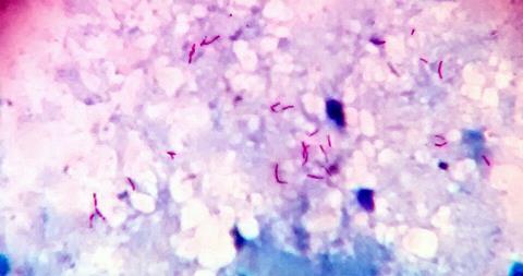 Acid_fast_bacilli_in_sputum_smear