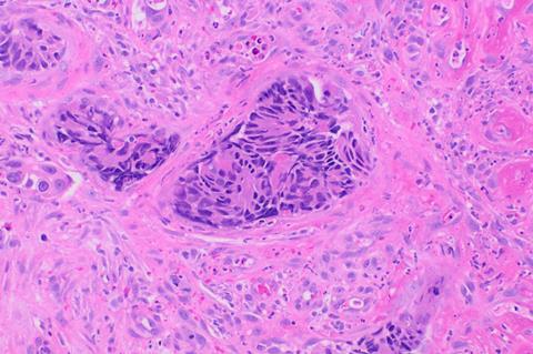 Histopathology_of_colorectal_adenocarcinoma_with_lymphatic_invasion