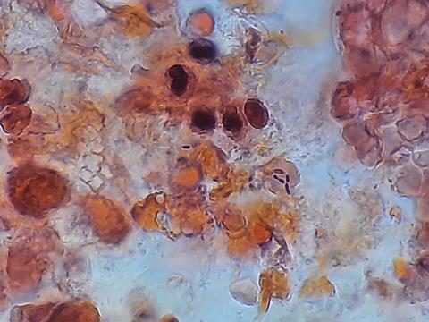 Pneumococcus_in_Gram-Stained_BAL_Sample