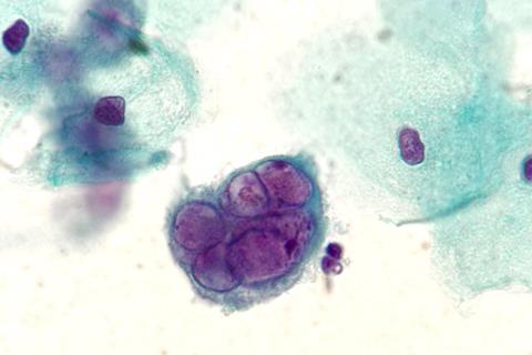 Herpes_on_Pap_test,_original