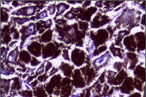 Histopathology_of_Malignant_melanoma