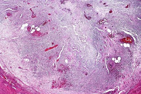 Acute_appendicitis,_low_mag.2