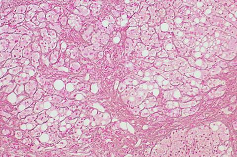 Cirrhosis_of_Alcoholic_Liver_Disease_(5517625829)