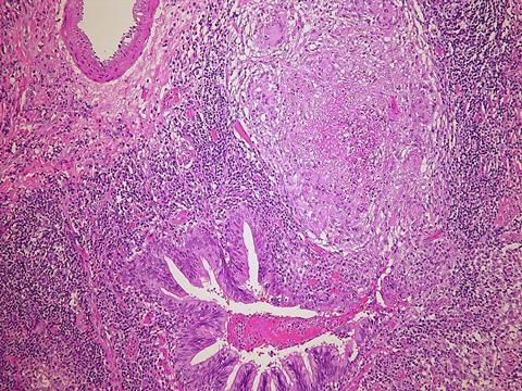 Bronchocentric_tuberculosis_Case_201_(6545170087)